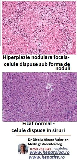 hiperplazie regenerativa nodulara a tratamentului hepatic